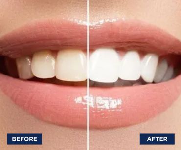 Smile before and after | Smile Makeover Farmington MI | Smile America Dental Center
