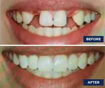 Before and After picture s |Smile Makeover Farmington Hills MI | Smile America Dental Center