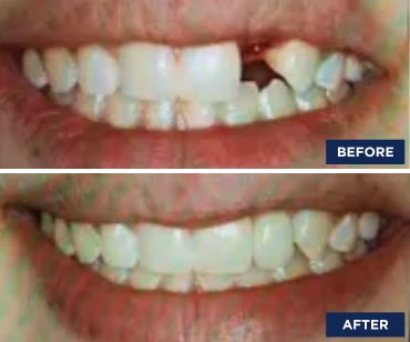 Before and After pic 2 | Dentist Farmington Hills MI | Smile America Dental Center