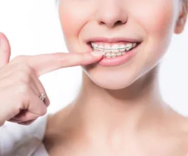 Braces | Pain Free Dentist Farmington Hills MI | Smile America Dental Center