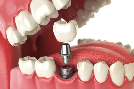 Dental Implants | Implant Dentist Farmington Hills MI | Smile America Dental Center