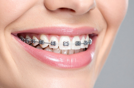 Dental Braces | Accepting New Patients Farmington Hills MI | Smile America Dental Center